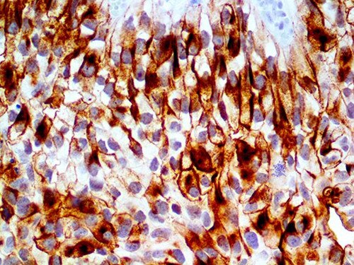 IHC of Uroplakin III on an FFPE Bladder TCC Tissue